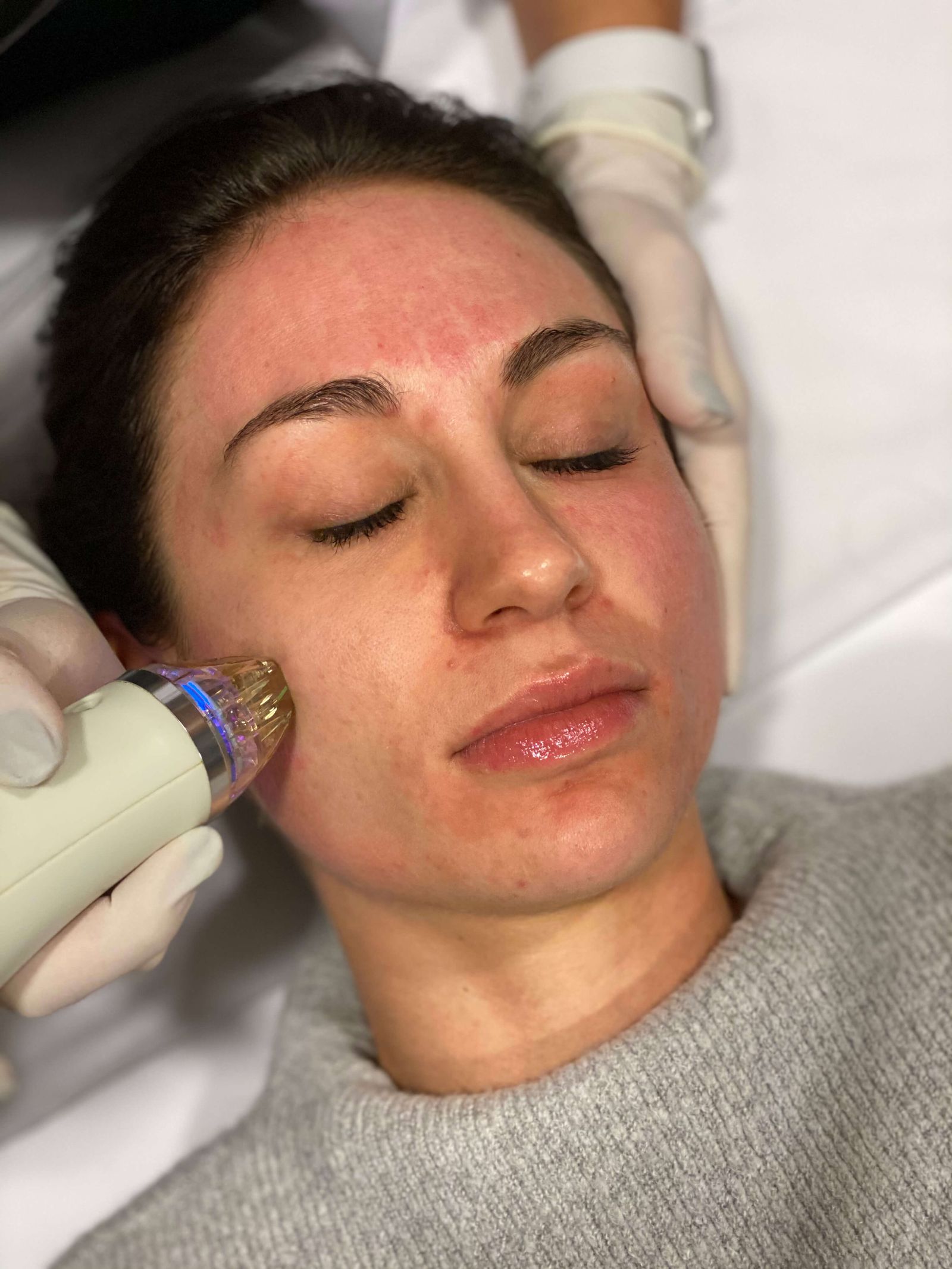 Radiofrequency Microneedling with Secret RF Vitahl Medical Aesthetics